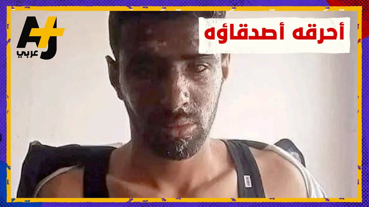 شاب جزائري أحرقه أصدقاؤه بماء النار والسبب الغيرة
