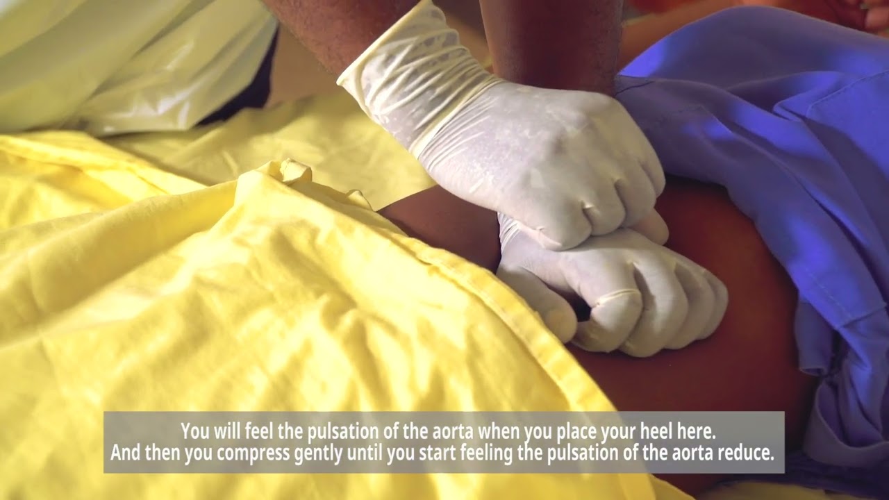 Aortic Compression in Postpartum hemorrhage management