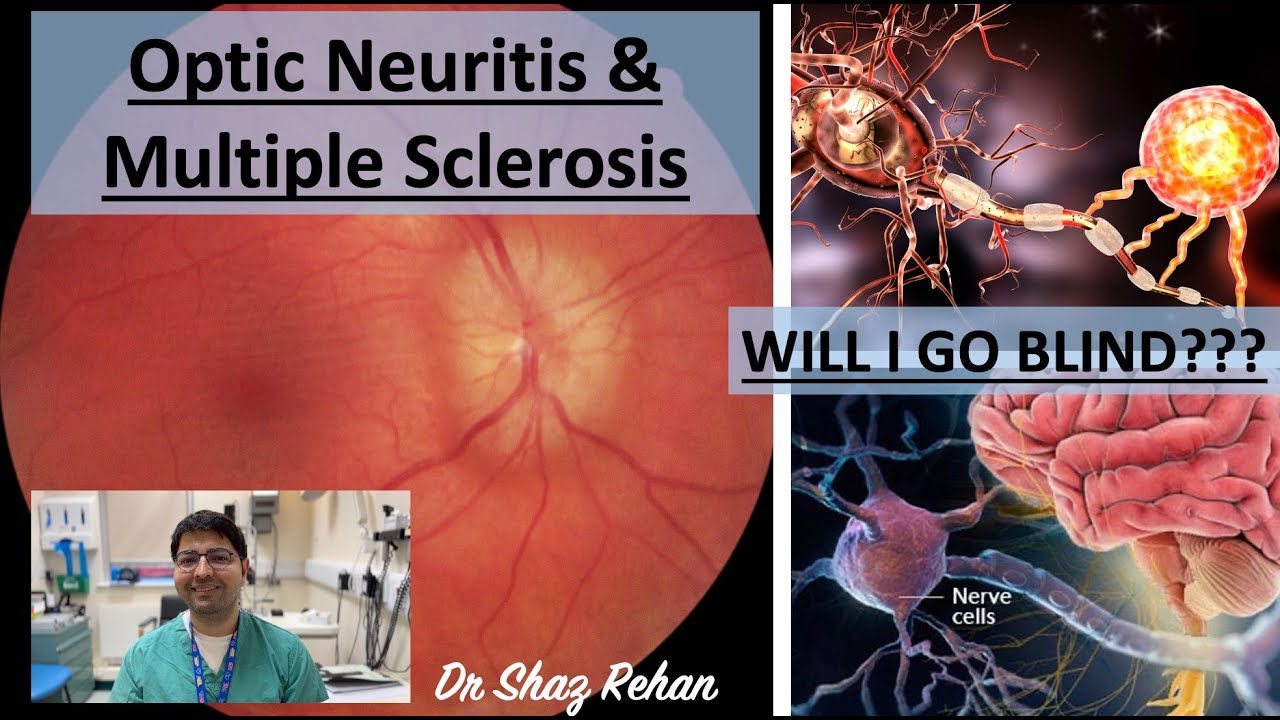 What is Optic Neuritis? What is Multiple Sclerosis (MS) I Eye Doctor Explains. 2023.