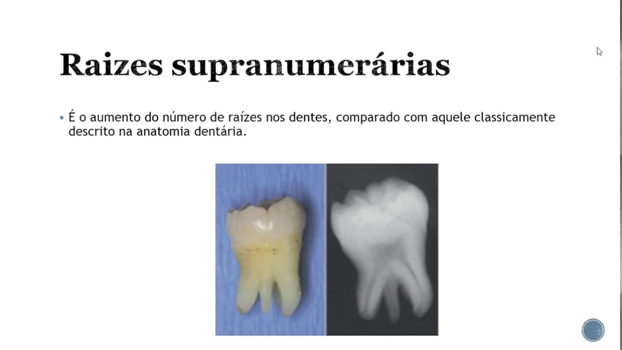 Alterações de desenvolvimento dos dentes (anomalias dentárias) *Resumos de odonto
