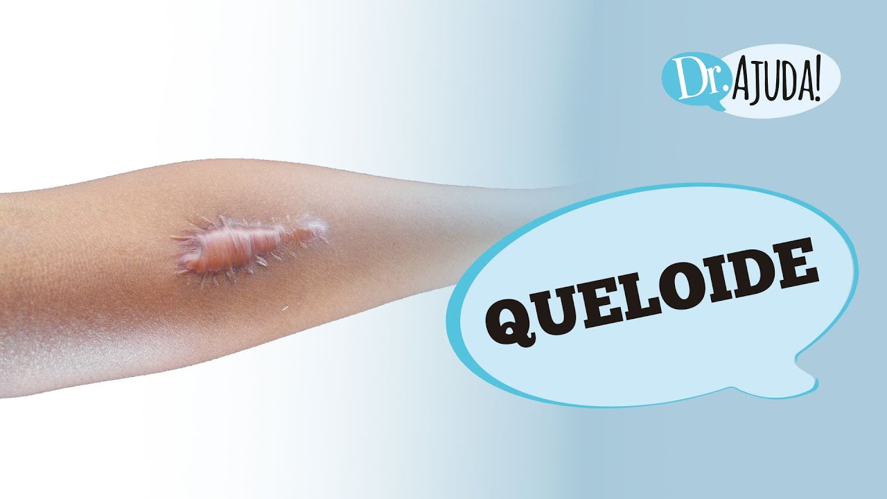 QUELOIDE: O QUE É, TRATAMENTO E COMO EVITAR