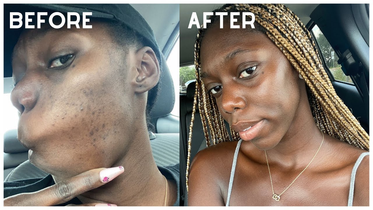 SKINCARE CONTRE LES BOUTONS, L' HYPERPIGMENTATION,  & TEXTURE (PEAU NOIRE) | Sassy Kassi