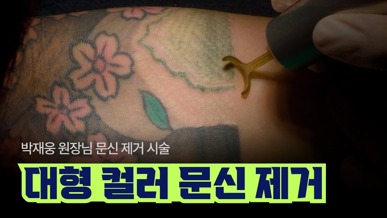 대형 컬러 문신 제거 시술 영상 [#문신제거]