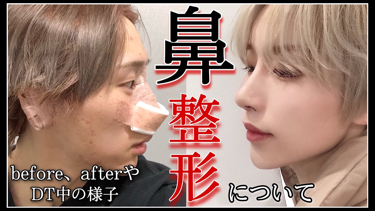 【鼻整形】人生変わる 
