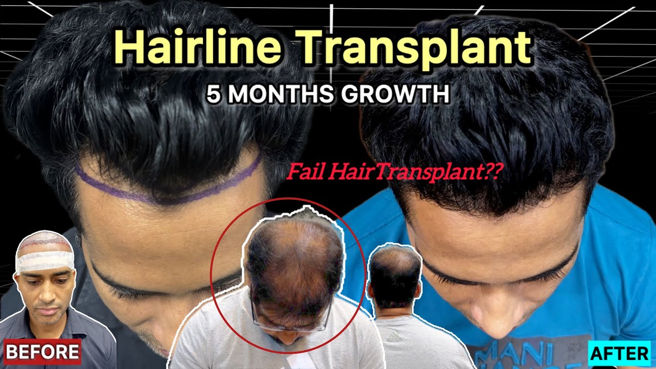 5 Month Hair Transplant Result & My Baldness after 9 Years of Hair Transplant 