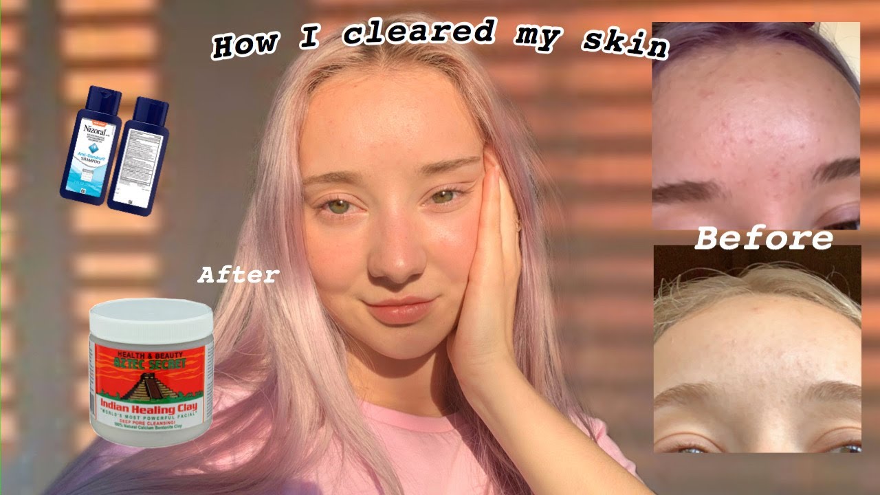 How I Cleared My Skin | Fungal Acne