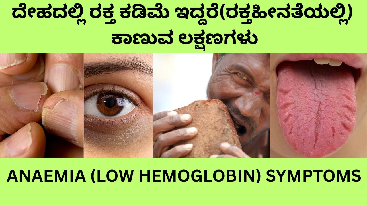 ANAEMIA OR LOW HEMOGLOBIN SYMPTOMS IN KANNADA.HEMOGLOBIN LESS CAUSES  AND TREATMENT IN KANNADA