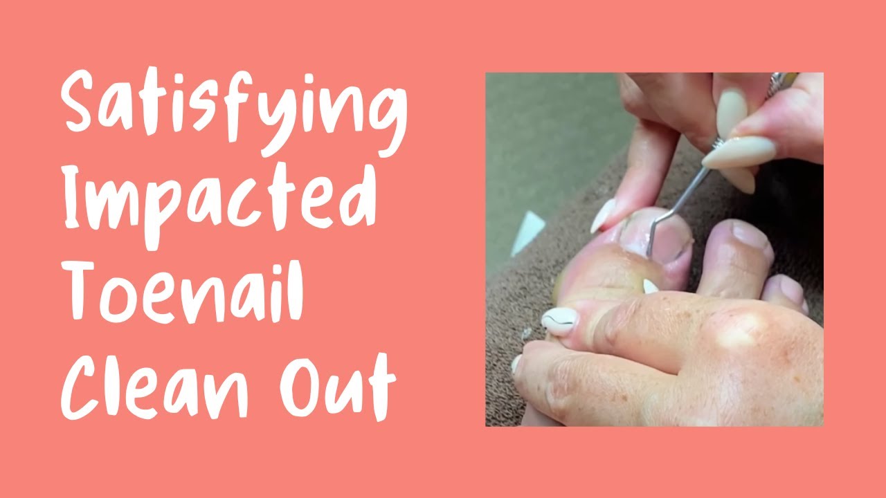 IMPACTED TOE NAIL CLEAN OUT #satisfyingvideo #impactedtoenail #nails #satisfyingvideo #hdh