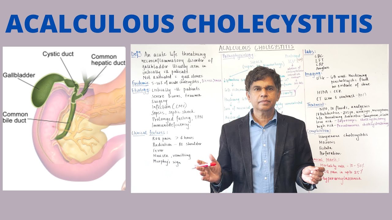 ACALCULOUS CHOLECYSTITIS - Quick Review - By Pramil Cheriyath MD