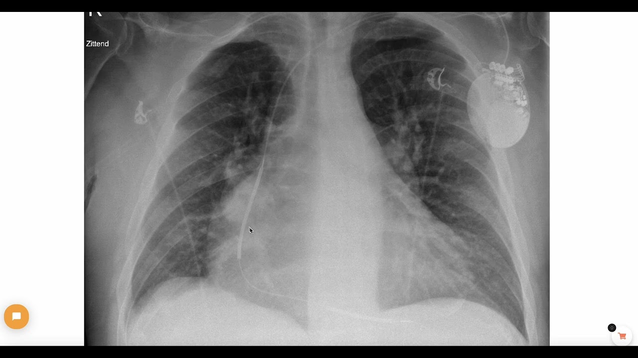 The difference between pacemakers and ICD's (on a chest X ray)