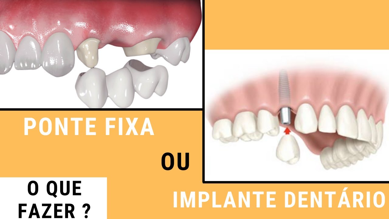 Fazer Ponte fixa ou Implante Dent&aacute;rio ? Existe um tratamento melhor ?