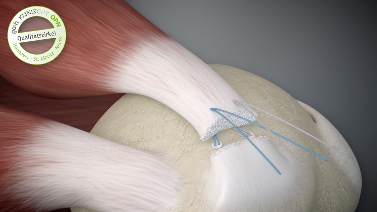 go:h - Arthroskopische Rekonstruktion der Rotatorenmanschette