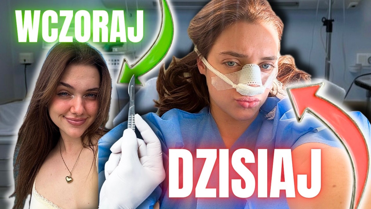 MOJA OPERACJA NOSA 👃