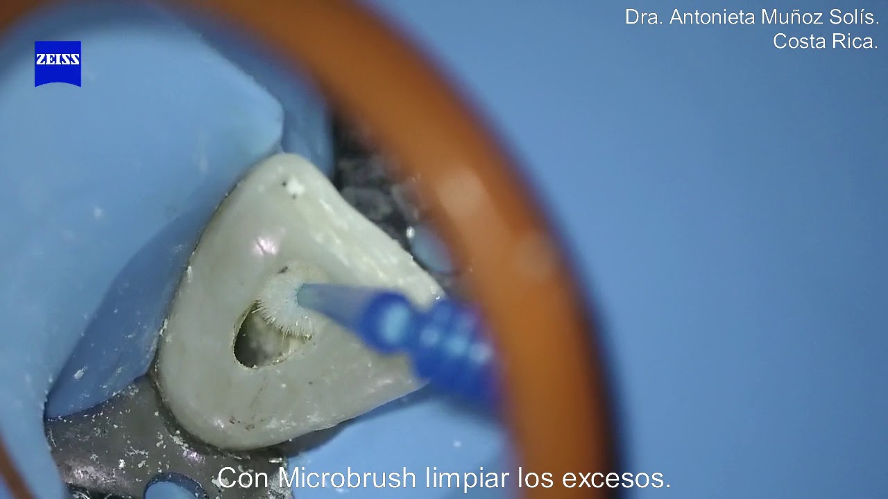 Selle apical con Biodentine (Septodont)