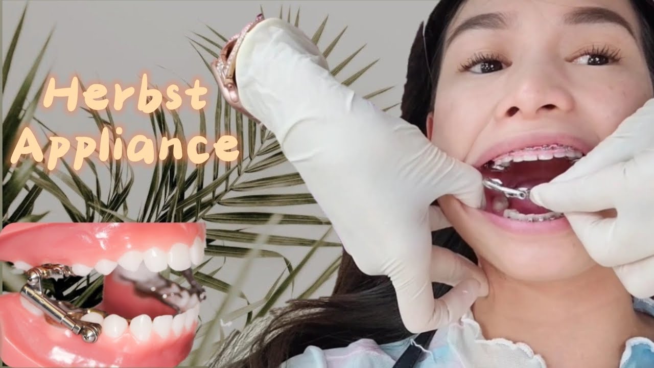 Attaching Lower part of my HERBST APPLIANCE and Braces Adjustment Vlog