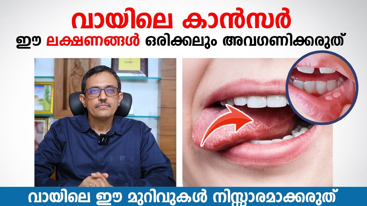 വായിലെ കാൻസർ ഈ ലക്ഷണങ്ങൾ ഒരിക്കലും അവഗണിക്കരുത് | Dr. Narayanankutty Warrier 