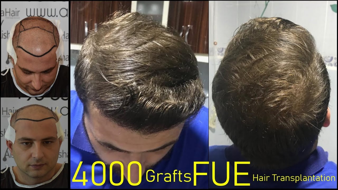 FUE Hair Transplantation Result at Aisha Hair / Resultados FUE Injerto Capilar en la Aisha Hair