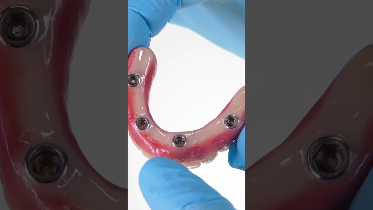 Pr&oacute;tese Protocolo em Zirc&ocirc;nia - Implace Implantes