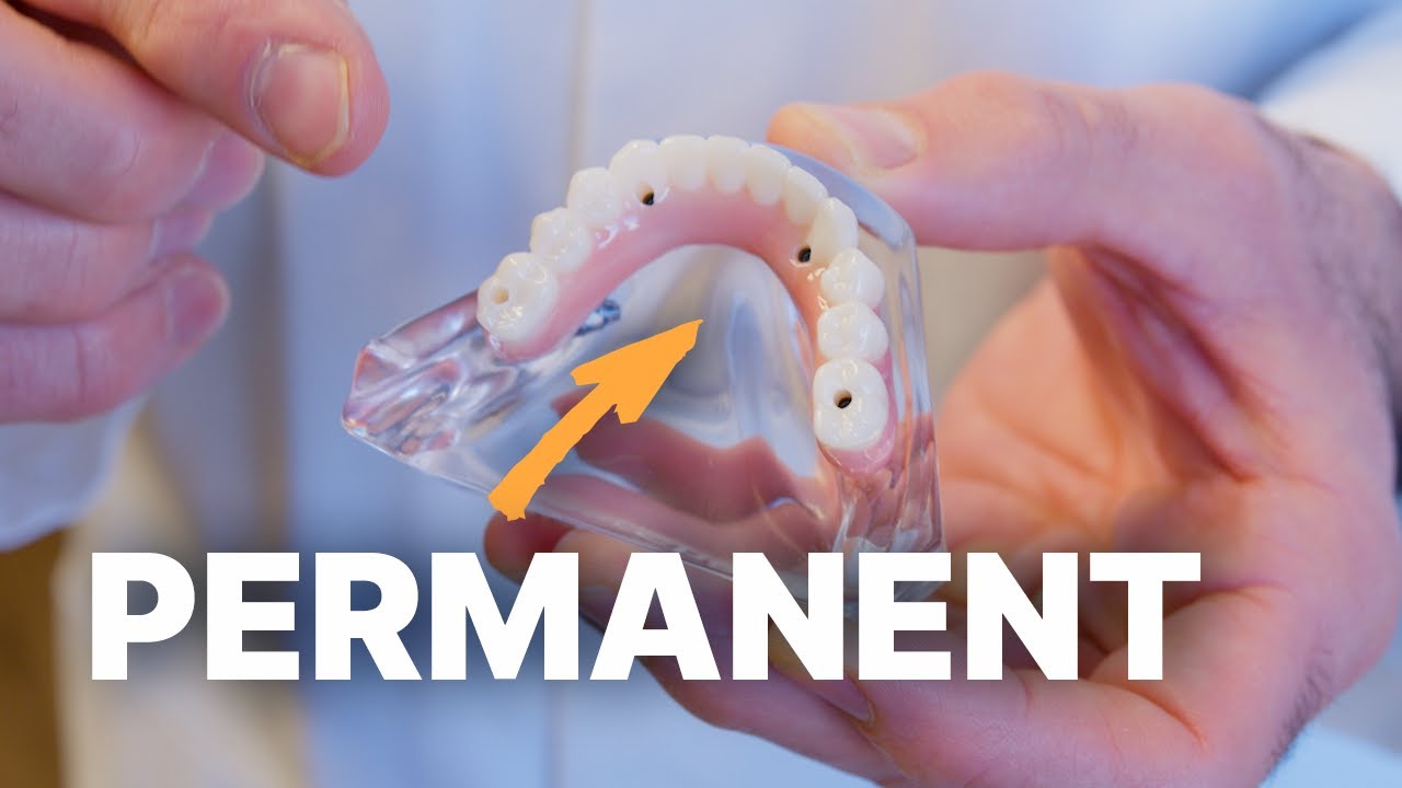 Strong, Secure, and Built to Last &mdash; The Truth About Implant Dentures