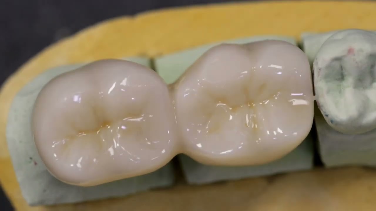 Posterior Zirconia Bridge Staining and  Glazing