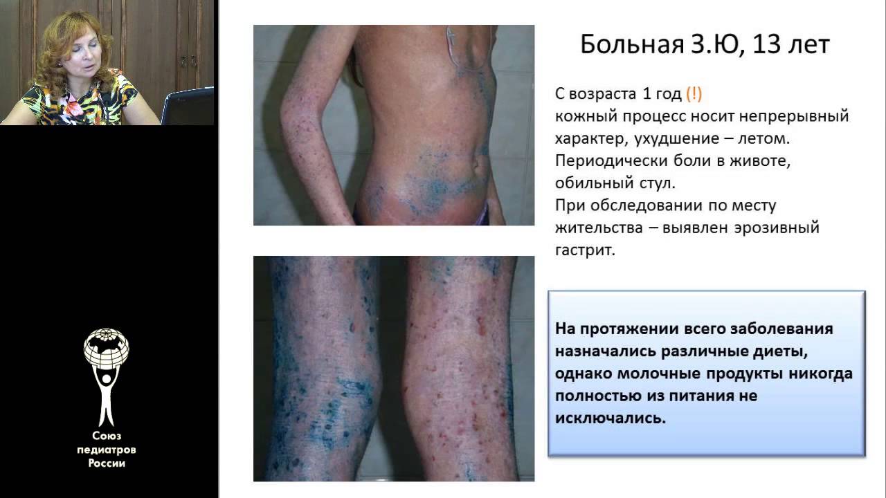 Пищевая аллергия. Часть 2. Макарова С.Г.