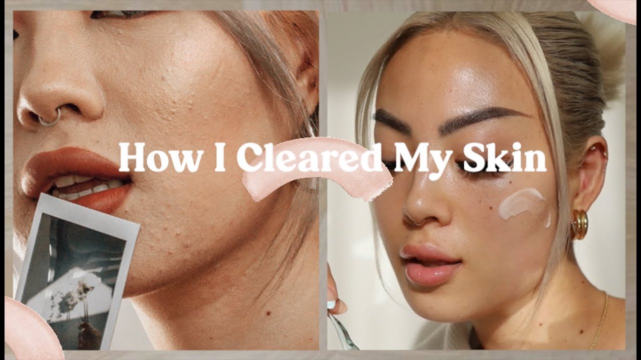 How I Cleared My Skin | acne & acne scars, skincare tips, lifestyle changes, self care tips