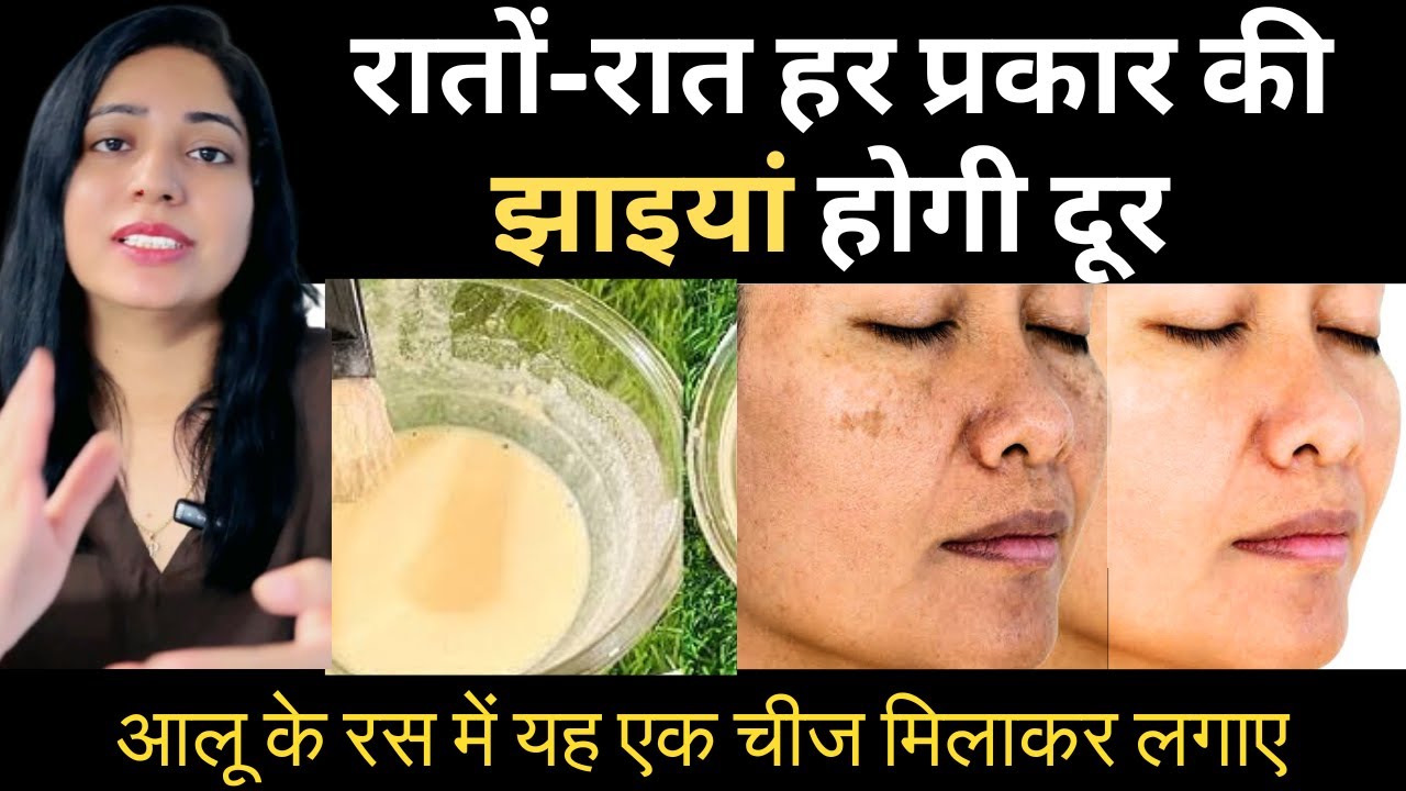 आलू के रस से करे रातोरात झाइयां दूर | Pigmentation Treatment At Home |