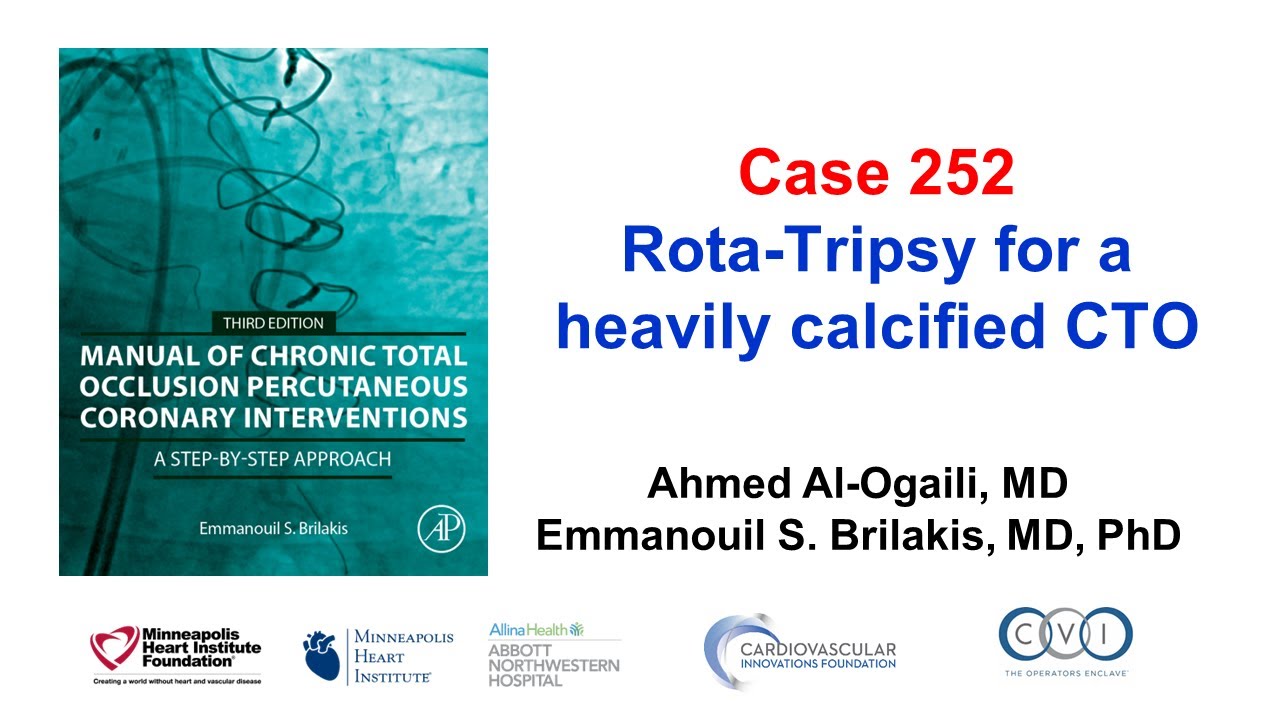 Case 252: Manual of CTO PCI - Rota-Tripsy for a heavily calcified CTO