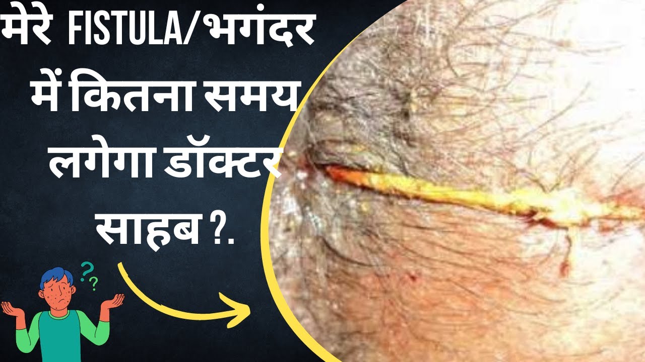 मेरे FISTULA/भगंदर में कितना समय लगेगा डॉक्टर साहब ?.