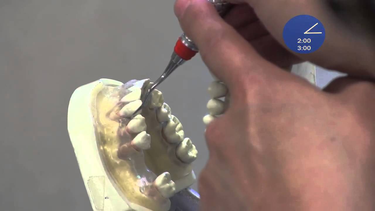 Maxillary Arch Fulcrum Reach Down Technique - Premolars and first molar mesials