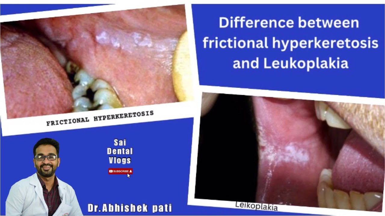 DIFFERENCE BETWEEN FRICTIONAL HYPERKERATOSIS AND LEUKOPLAKIA