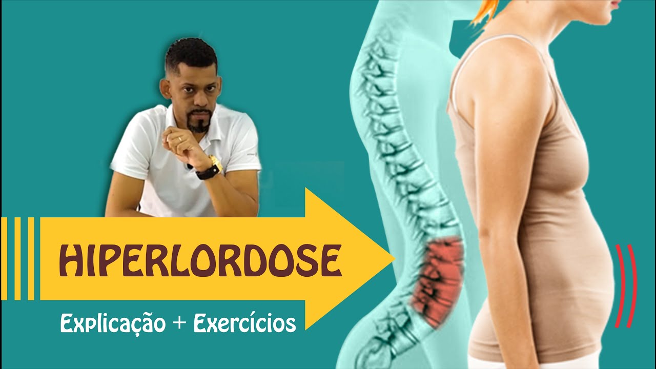 Hiperlordose  - O que é?  | Vídeo c/ exercícios para a postura e para evitar a barriga pra frente