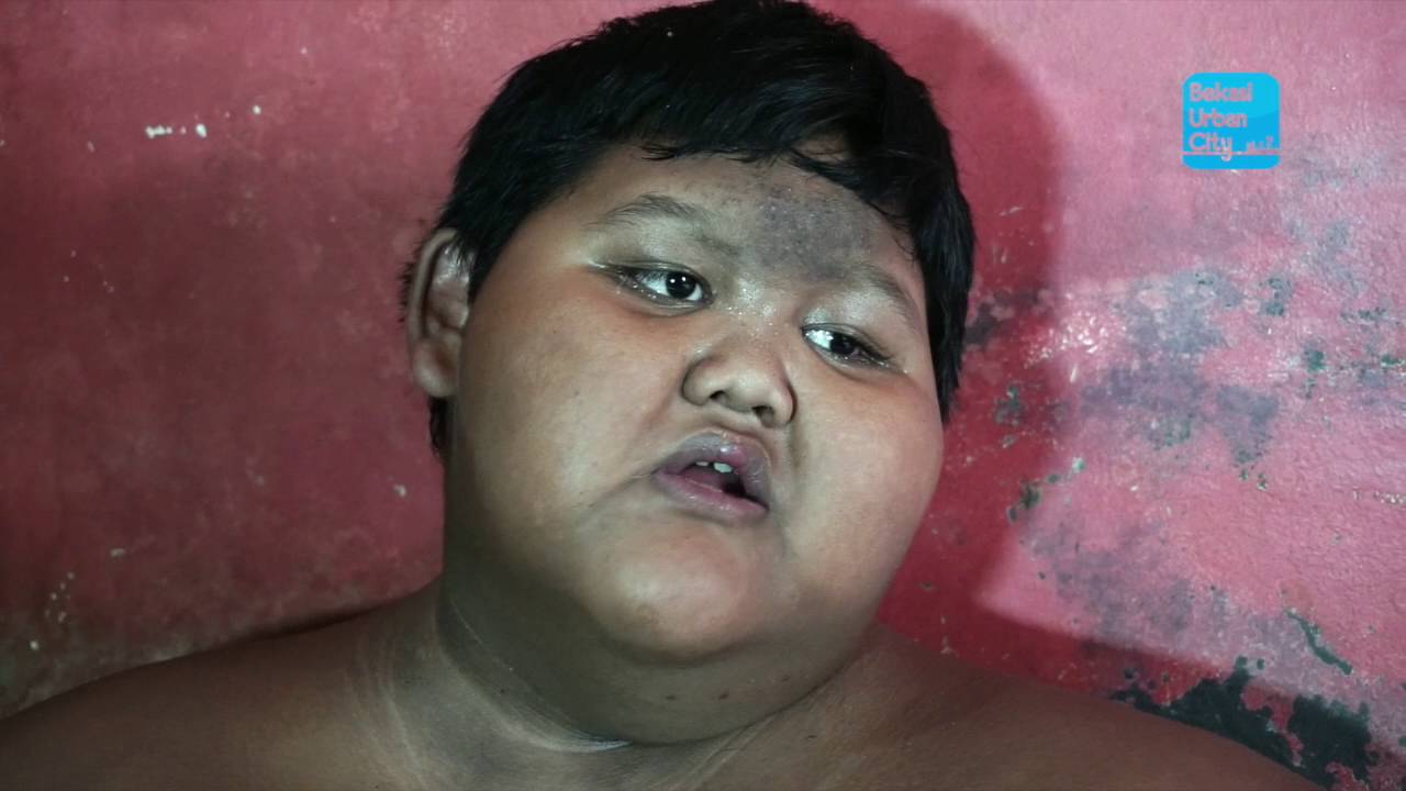 Arya Permana, Kisah Bocah 10 Tahun Dengan Bobot Tubuh 190 Kg
