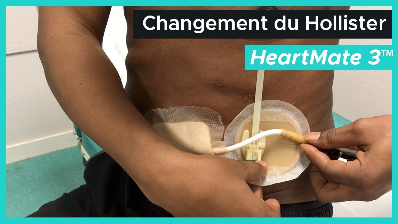 Changement du Hollister avec le HeartMate 3™