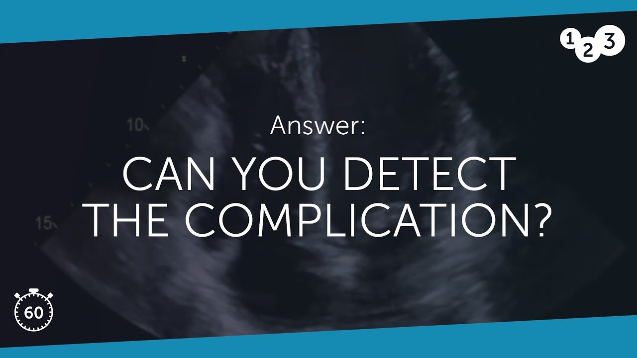 60 Seconds of Echo Teaching Answer: Can you detect the complication?