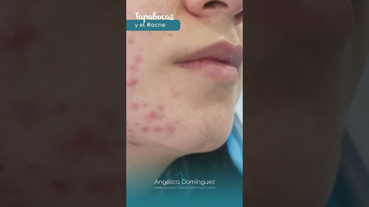 Acné por el Uso del Tapabocas - Dr. Angélica Domínguez Dermatóloga en bogotá