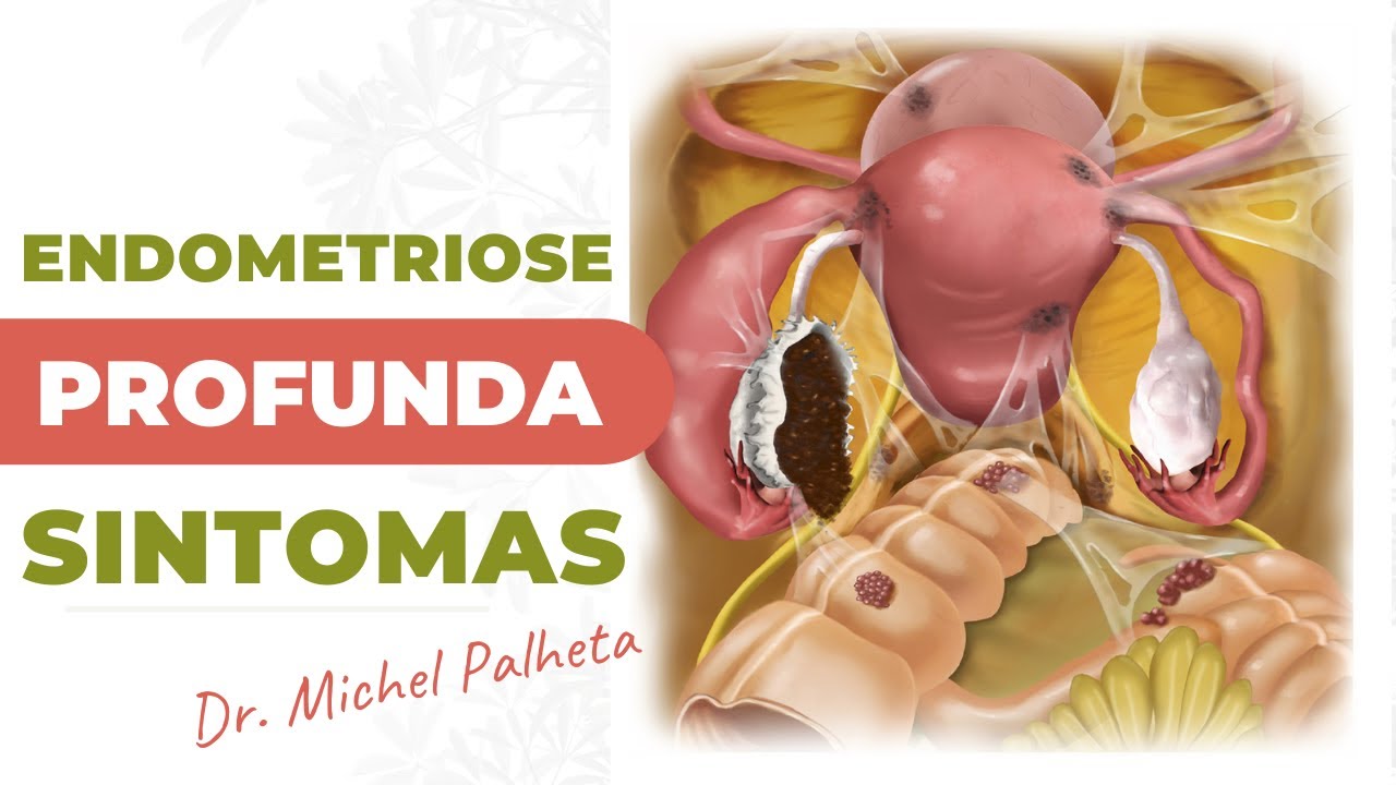 Quando a ENDOMETRIOSE é considerada profunda?