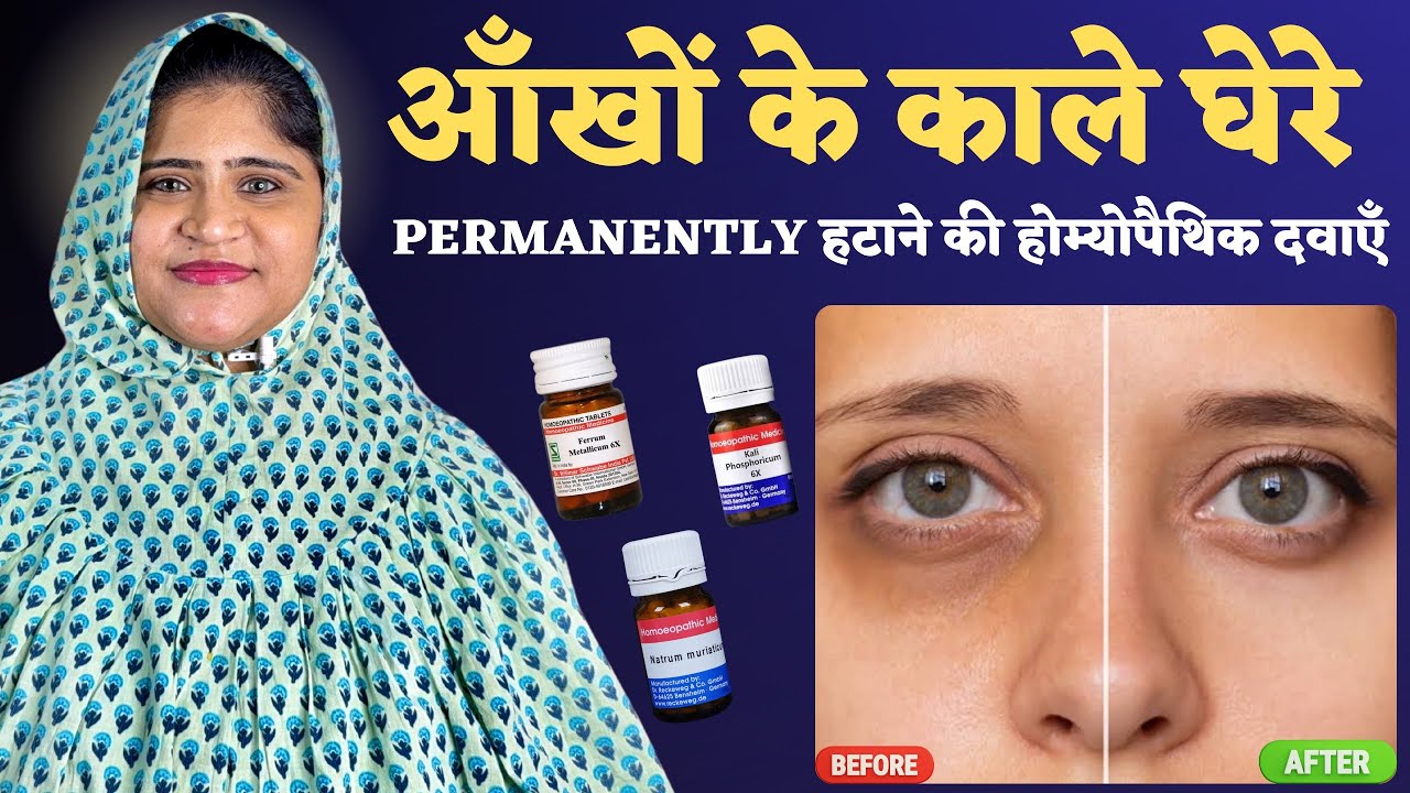 Remove Dark Circles : Top 5 Homeopathic Medicines for Dark Circles |@DrArwaBohra​