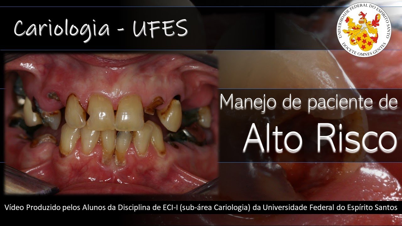 PACIENTES DE ALTO RISCO À CÁRIE DENTAL. #cariologia #ufes