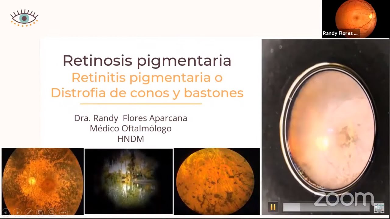 RETINOSIS PIGMENTARIA