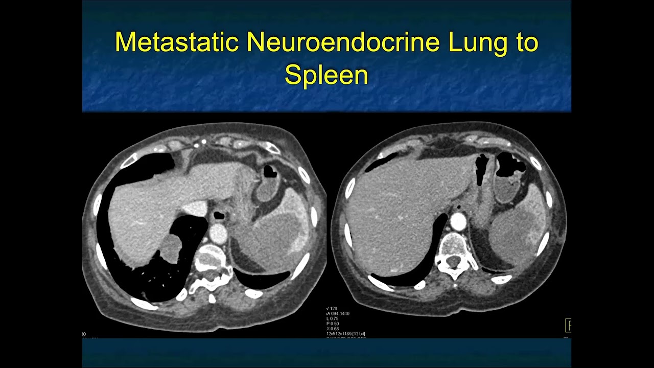 MDCT Evaluation of the Spleen: Challenges in Diagnosis - Part 4