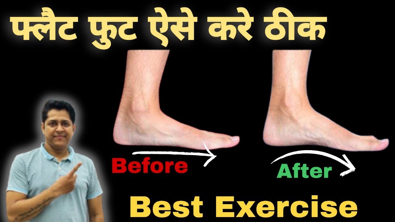 Best Exercise For Flat feet in hindi. फ्लैट फुट कैसे ठीक करे। flat foot correction Exercise at home.