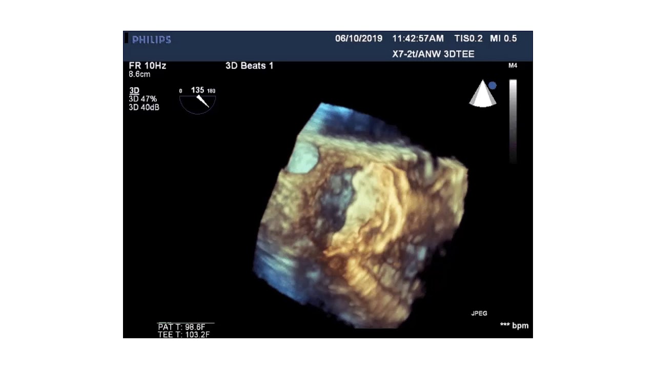 Difficult LAA closure - Mario Goessl, MD
