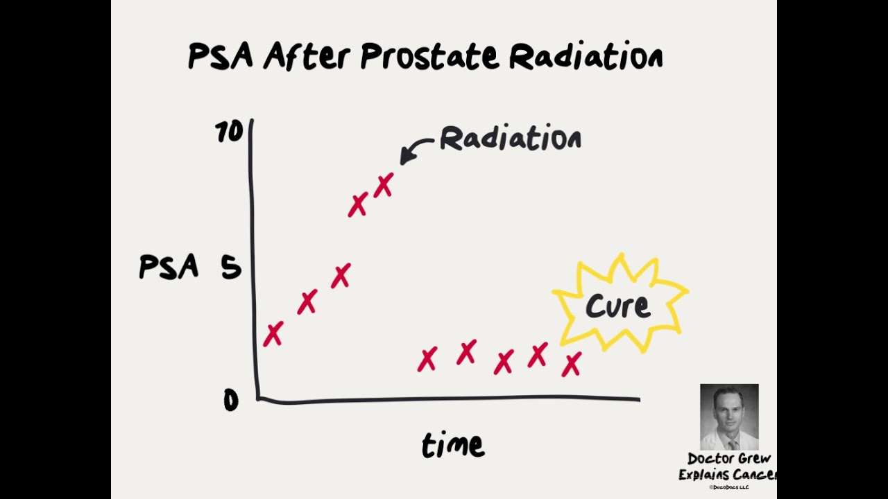 Doctor Explains PSA after Radiation for Prostate Cancer