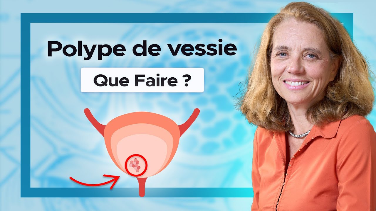 Polype de vessie : qu’est-ce que c’est et comment le traiter ? Réponse du Dr Laurence Peyrat