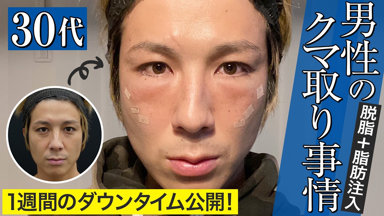 【目の下のクマ】クマ取りダウンタイム　脱脂＋脂肪注入メンズ版！【湘南美容クリニック】