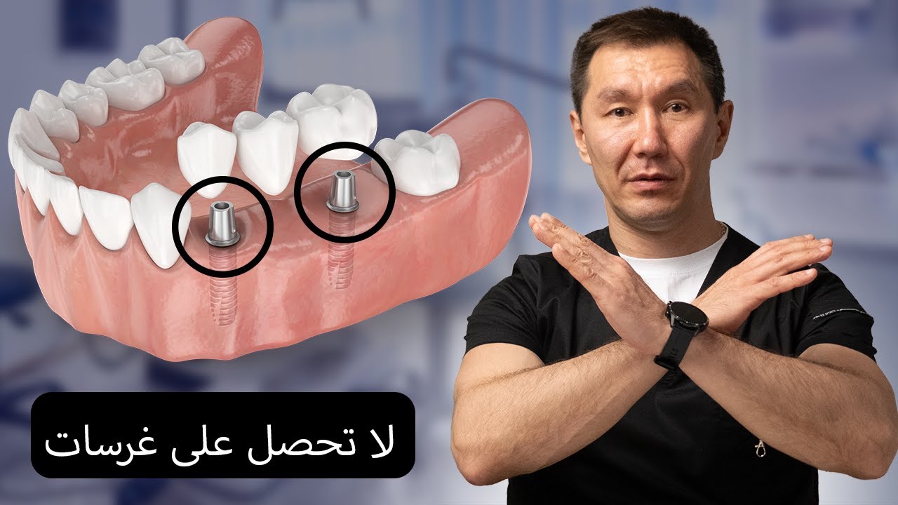 لا تُجرِّب زراعة أسنان قبل أن تعرف هذا! أطباء الأسنان لا يخبرونك الحقيقة