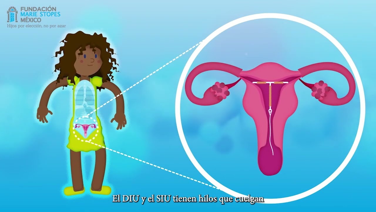 DIU y SIU. Ventajas y diferencias.