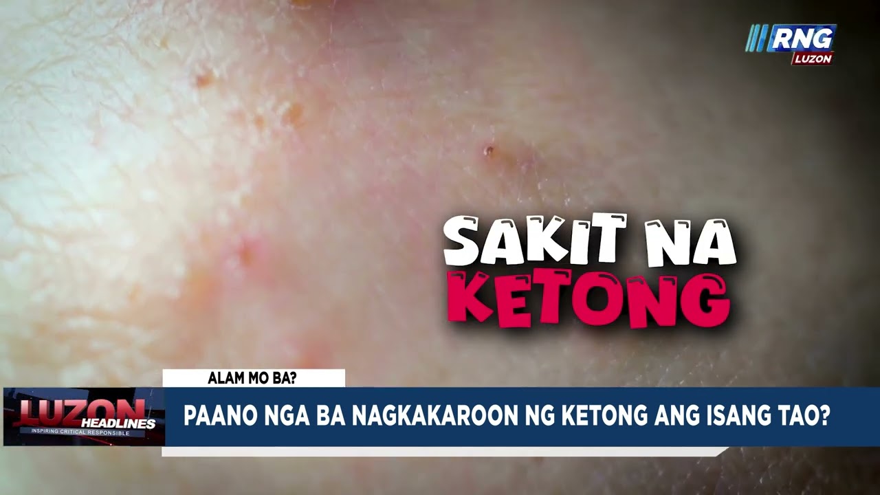 Paano nga ba nagkakaroon ng ketong ang isang tao?