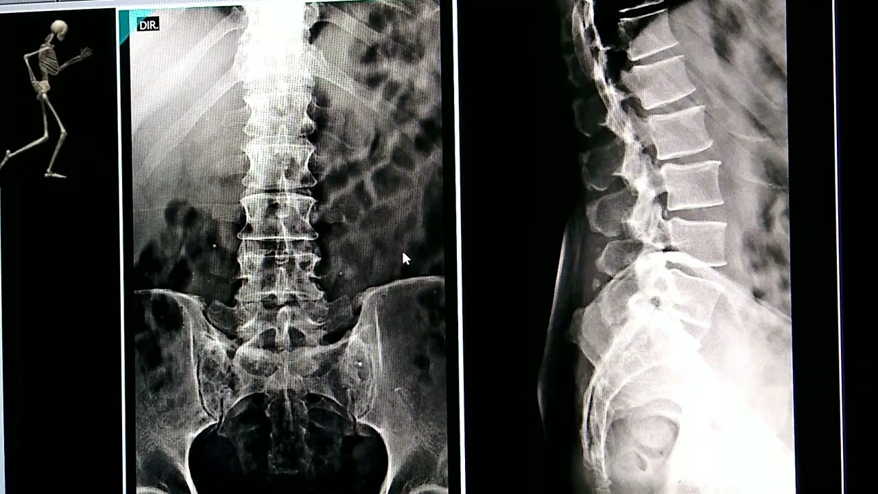 RX Coluna Lombar, Anatomia Radiológica.